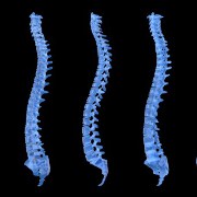 Cervical Myelopathy related image